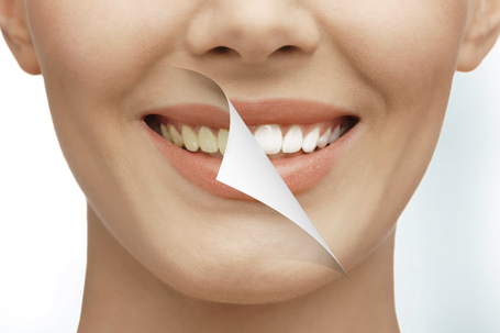 teeth whitening miami